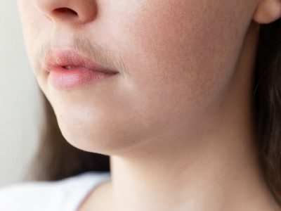 Hirsutisme Pada Wanita Penyebab, Dampak & Cara Mengatasinya
