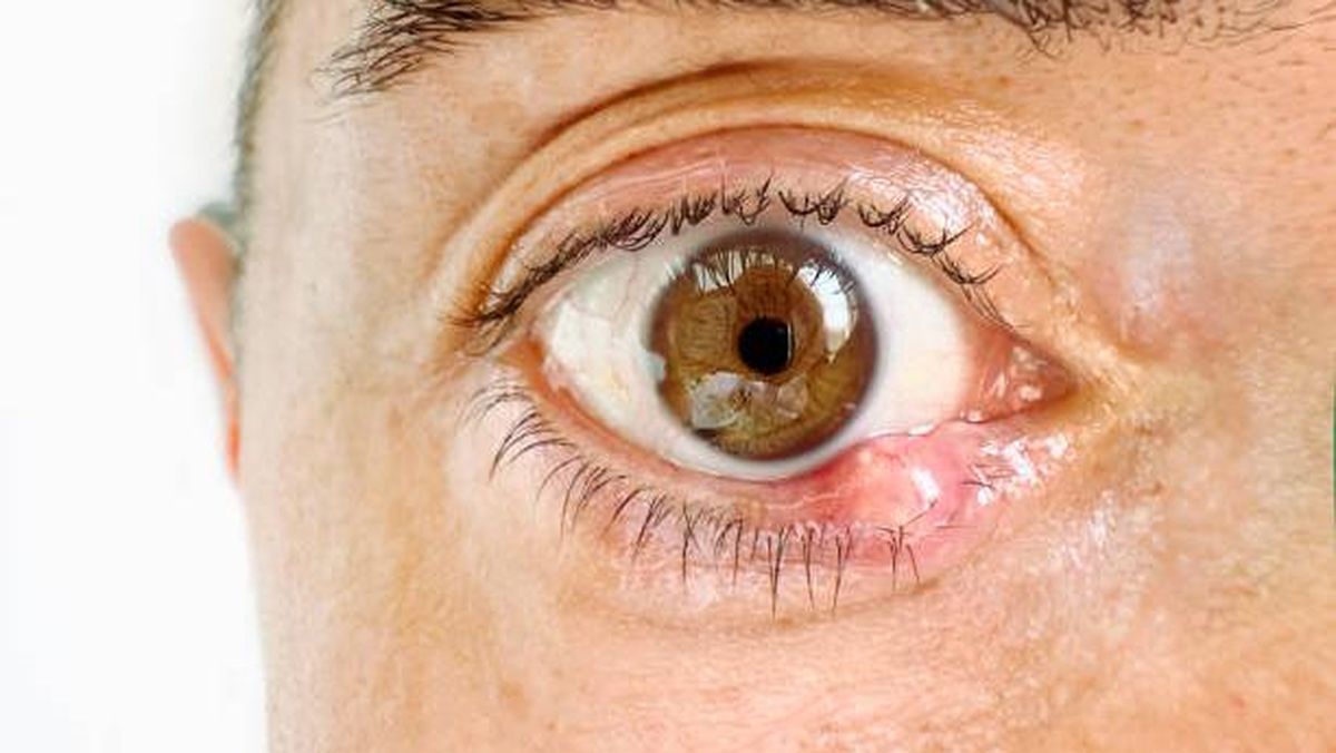 Kalazion Benjolan Di Kelopak Mata Yang Sering Di Sangka Bintitan