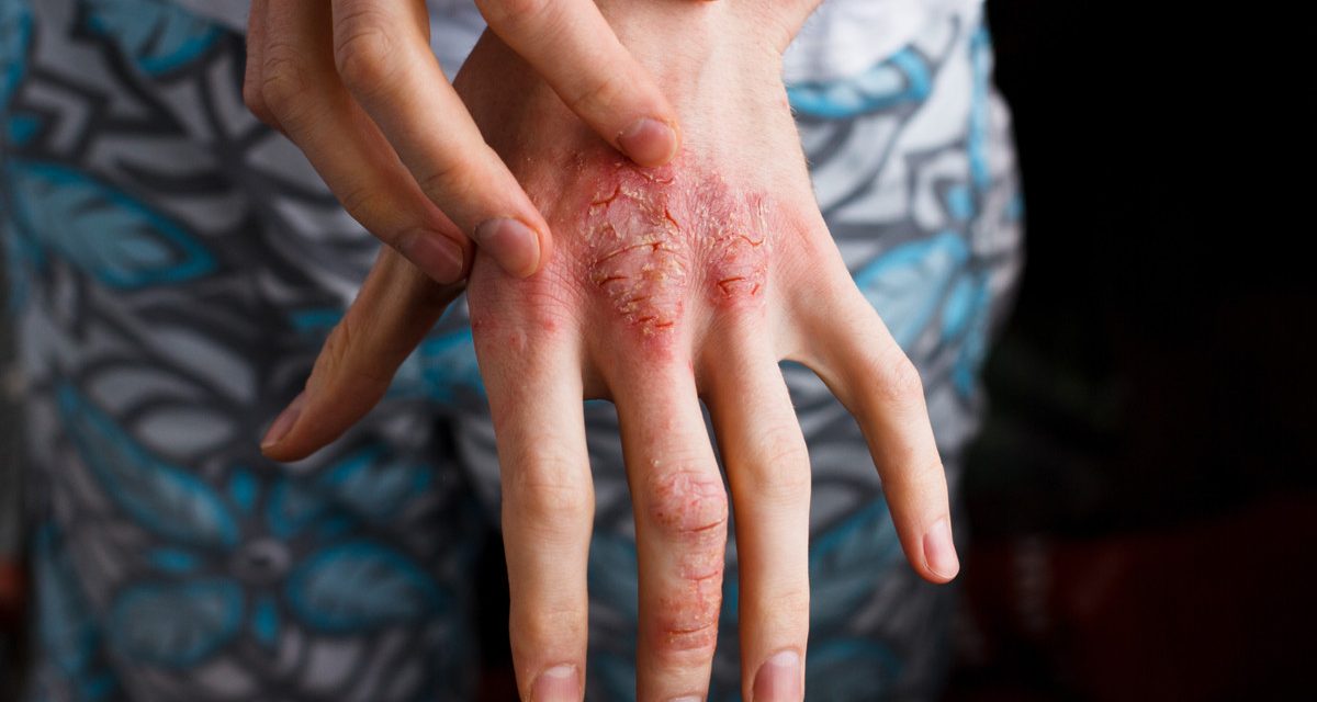 Dermatitis Atopik, Penyakit Kulit Kronis Perlu Penanganan Tepat
