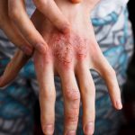 Dermatitis Atopik, Penyakit Kulit Kronis Perlu Penanganan Tepat