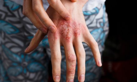 Dermatitis Atopik, Penyakit Kulit Kronis Perlu Penanganan Tepat