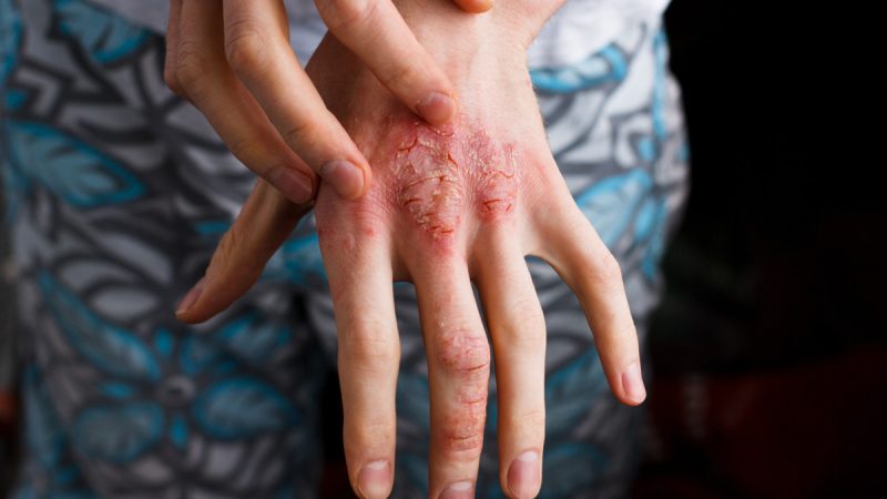 Dermatitis Atopik