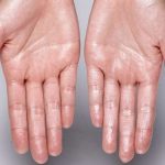 Hiperhidrosis, Kondisi Keringat Berlebihan Pada Tangan Dan Kaki