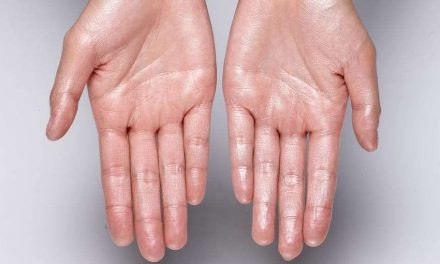 Hiperhidrosis, Kondisi Keringat Berlebihan Pada Tangan Dan Kaki