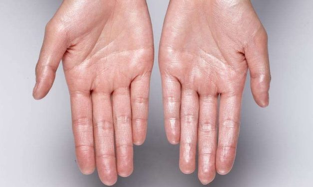 Hiperhidrosis, Kondisi Keringat Berlebihan Pada Tangan Dan Kaki