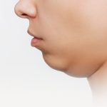 Double Chin Bikin Sebal Karena Mengganggu Penampilan