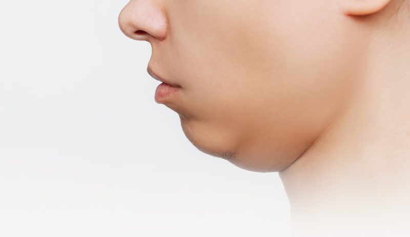 Double Chin