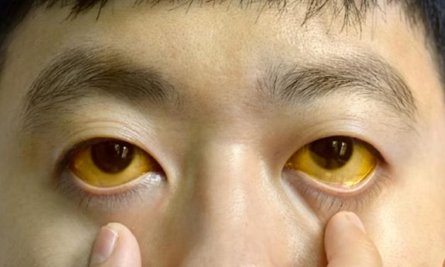 Demam Kuning Penyakit Mematikan Yang Terus Ancam Dunia