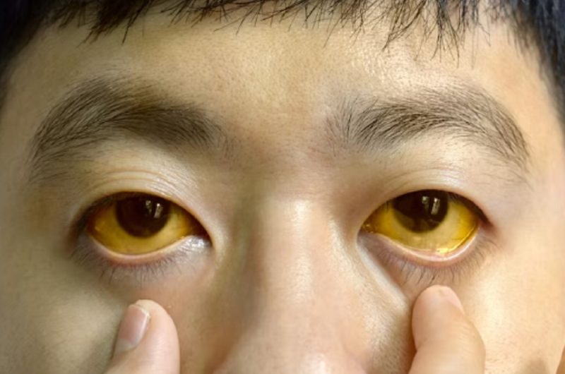 Demam Kuning
